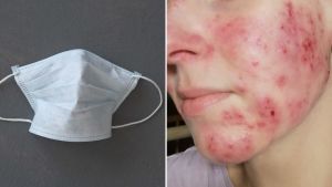 Efter att Kati använt munskydd i sitt arbete, fick hon en kraftig hudreaktion. Hon har känslig hud sedan tidigare, men blev mycket förvånad över den skada munskyddet åstadkom och hon undrar vad munskydden egentligen kan innehålla. Tudelad bild: till vänster ett engångsmunskydd, till höger en kvinna med utslag i ansiktet