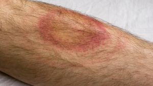 80 eller 90 procent av borreliossjukdomarna är tidiga tecken på huden, alltså en rodnad som så att säga "vandrar" på huden. Utslag som tyder på borrelios.