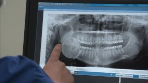 Sju personer som jobbar inom de privata vårdkedjorna vittnar om övervård på patientens bekostnad i Svenska Yles gräv. En tandläkare granskar en panoramabild.