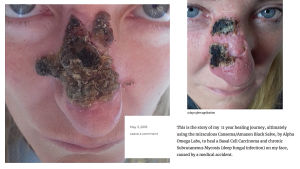 Mustan salvan aiheuttamaa ihovauriota naisen nenässä.