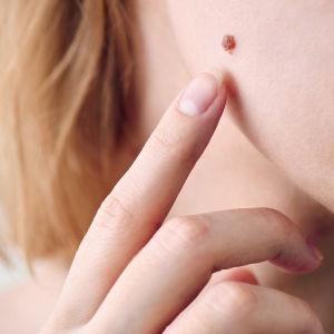 Tekoäly voisi kuvan perusteella kehottaa näyttämään luomea lääkärille. luomi nuoren naisen poskella
