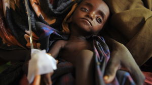 Ett svårt undernärt barn i Somalia år 2011. Ett svårt undernärt barn i Somalia år 2011.