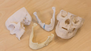 Ny teknologi: 3D-printade modeller och mallar kan bli viktiga verktyg för kirurgerna i arbetet med ansiktsskador i framtiden. 3D printad skalle