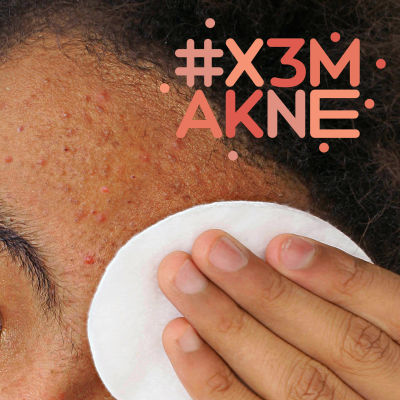 Närbild på aknehud med #x3makne logo