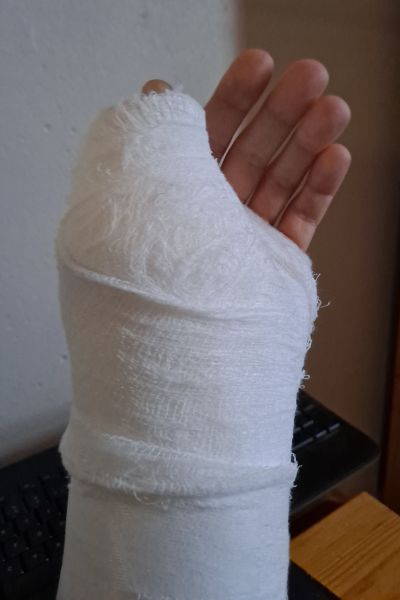 Gipsad hand och arm.