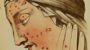 Smittkoppor, mänsklighetens urgamla gissel, numera utrotad. Illustration av smittkoppor.