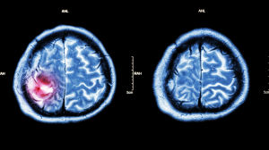 Dödsfallen till följd av bland annat cancer minskar med i snitt två procent per år. Hjärntumör på datortomografibild.