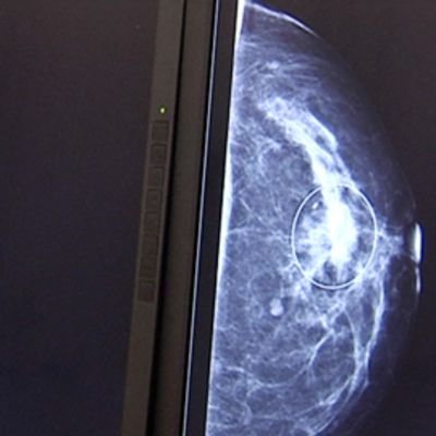 Mammografiakuva naisen rinnassa olevasta syöpäkasvaimesta.