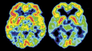 PET-kuva Alzheimerin tautia sairastavan aivoista