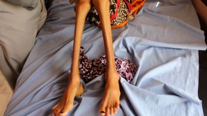Tolvåriga Fatima Hadi vårdades för sin akuta undernäring på ett sjukhus i Hajjah i slutet av februari. Tolvåriga Fatima Hadi vårdades för sin akuta undernäring på ett sjukhus i Hajjah i slutet av februari.