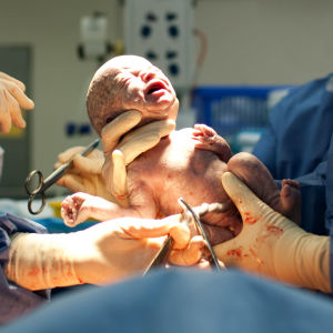 En nyfödd bebis efter kejsarsnitt.