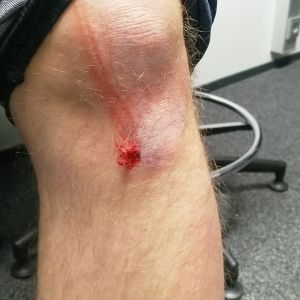 Koagulering är kroppens sätt att hindra blodförlust vid skador. Radiotoimittaja Kalle Mäkelä kaatui aamun liukkaassa kelissä.