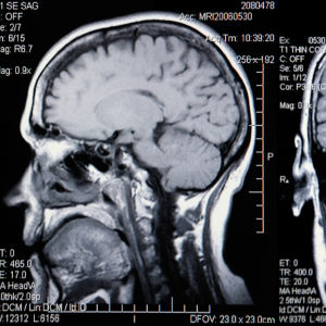 Hjärnan avbildad med en magnetkamera.
