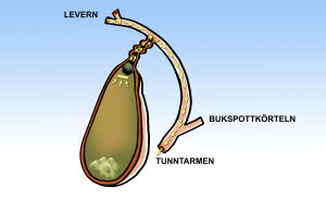 Om stenen täpper till gallblåsans utförsmynning kan blåsan infekteras. Symptomen är ihållande smärta och feber. Illustration: YLE/Mikael Lehtelä Om stenen täpper till gallblåsans utförsmynning kan blåsan infekteras. Symptomen är ihållande smärta och feber