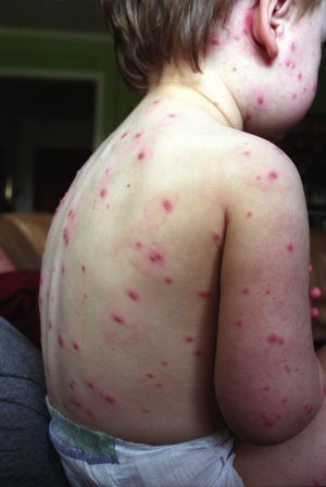 När det kommer till mindre allmänna vaccin är täckningen för vaccinet mot vattkoppor 80 procent i hela landet, men 55,6 procent i Österbotten. Barn med vattkoppor