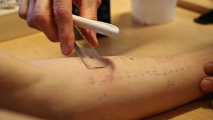 Pricktesten visade ingen allergi mot tomater och tomatplantor för Jan Smith. En sjukskötare utför pricktest på en man. I bilden syns mannens arm som är fylld av med kulspetspenna skrivna siffror samt röda prickar.