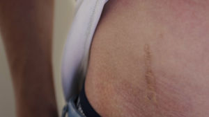 Så här ser Jeres transplantationsärr ut. Ett ärr efter en njurtransplantation