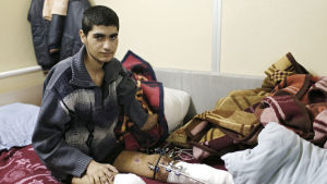 Ahmed Dabu som förlorade en arm och ett ben i flygangrepp i Syrien på sjukhus i turkiska Kili Ahmed Dadu från Syrien har förlorat en arm och ett ben i flygräder.