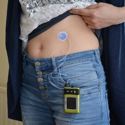 Insulinpumpen har underlättat Marias vardag med diabetes.