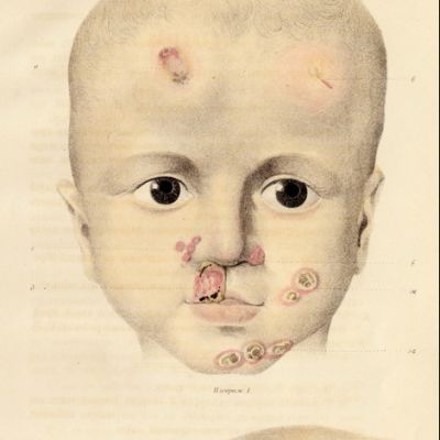 Suomalaisten lääkärien käytössä oli Venäjällä 1867 painettu V. Tarnovskin Kuppa-atlas, jossa värikuvin havainnollistetaan taudin monivaiheinen kehittyminen.