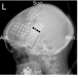 Ett kollage av ljudkurvor och en röntgenbild av ett huvud med elektroder.