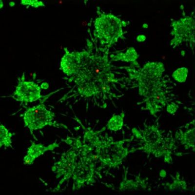Tre-dimensionell (3D) cellkultur av aggressiva prostatacancer celler (gröna) som invaderar ut i den närliggande omgivningen.