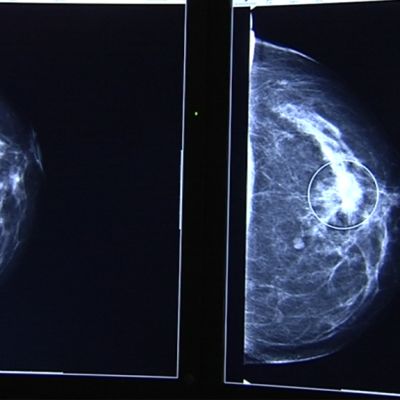Mammografiakuva.