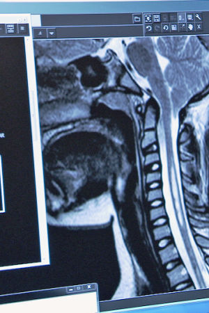 Chiari-potilaan röntgenkuva