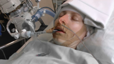 En kvinna ligger i en sjukhusbädd med slutna ögon och slangar kopplade till huvudet och ansiktet. 