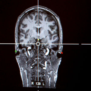 Kaksi röntgenkuvaa aivoista.