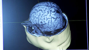 Tietokoneen ruudulla kolmiulotteinen kuva aivoista.