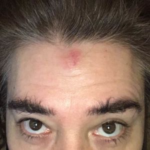 Regissören bankade huvudet i asfalt för ljudeffektens skull och så gick det så här. Jessica Edén med sår i pannan.