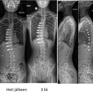 Röntgenbilder på skoliospatient. 