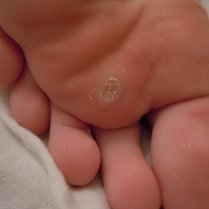 fixa nageltrång hemma fixa nageltrång hemma