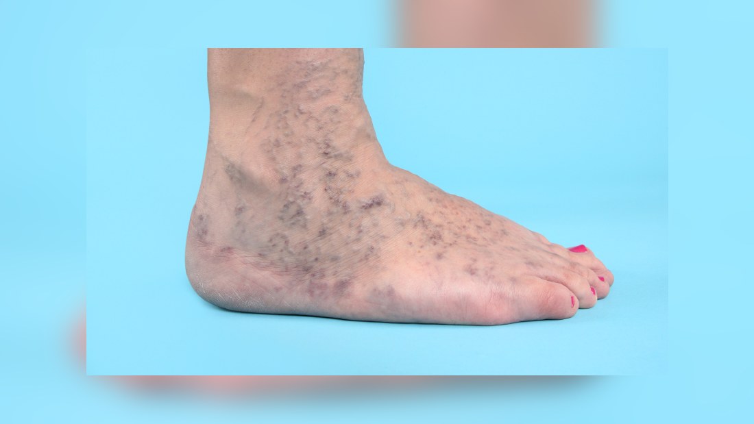 inflammation i blodkärlen i benen inflammation i blodkärlen i benen