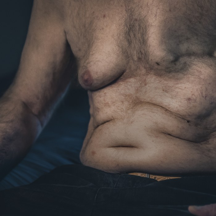 grön vätska från bröstet grön vätska från bröstet