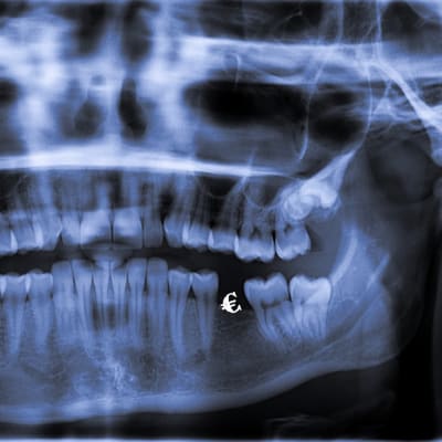 En panoroamröntgen av en mun, ett litet eurotecken syns i en av tandgluggarna.