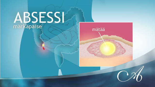 Abskessi – Omalääkäri – yle.fi