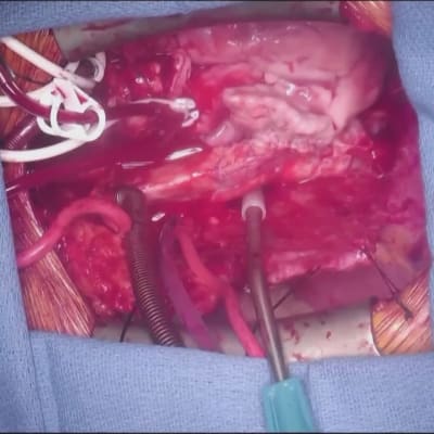 En närbild på grishjärtat när det redan pumpar i patientens kropp. 