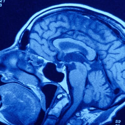 Röntgenkuva aivoista