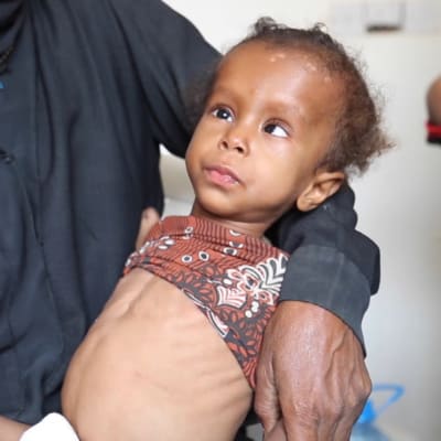 Mansour ja Suha näkevät nälkää - kuten yli 5 miljoonaa jemeniläistä lasta
