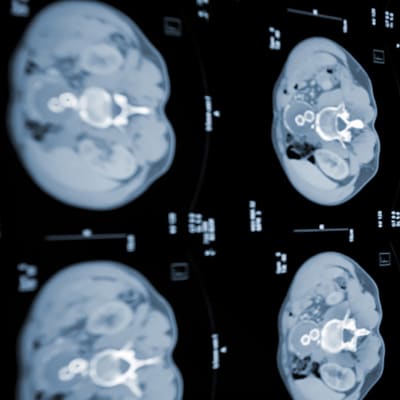 Flera röntgenbilder på hjärnan.