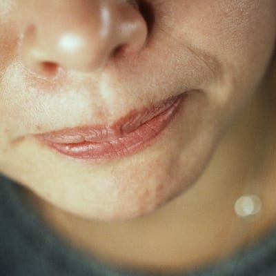 Tandgnissling beror ofta på stress. Bild: YLE/Jyrki Lyytikkä