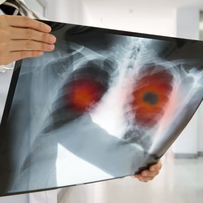 Lääkäri tutkii keuhkoista otettua röntgenkuvaa.
