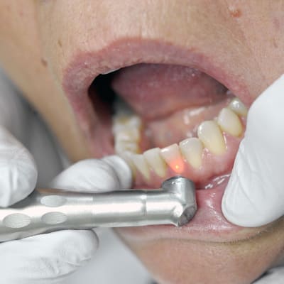 Hampaita paikataan hammaslääkärissä.
