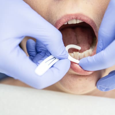 Hammaslääkäri puhdistaa potilaan hammasväliä.