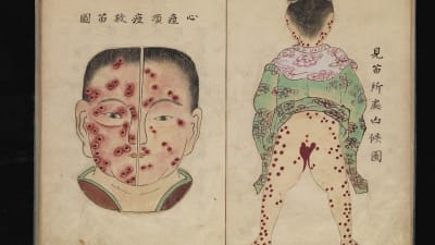 Japanska illustrationer från 1700-talet av smittkoppor