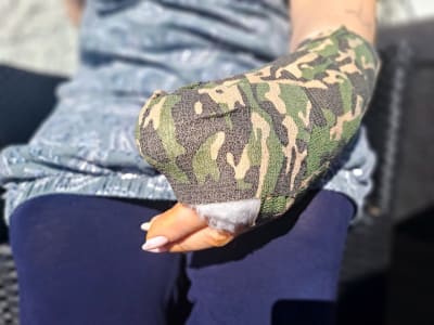 En persons hand, med ett gips som har kamouflagemönster. Kvinnans naglar är målade rosa.