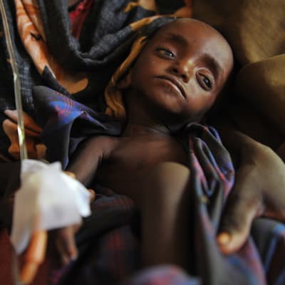 Ett svårt undernärt barn i Somalia år 2011.