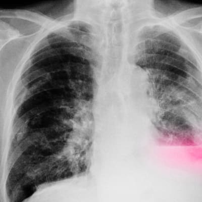 keuhkot röntgenkuvassa